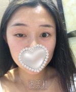 双眼皮一宽一窄失败了吧，修复好了又是美女一枚 width=