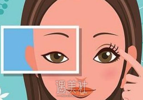 曾海峰医生双眼皮案例曝光｜内含亲身体验果图 width=