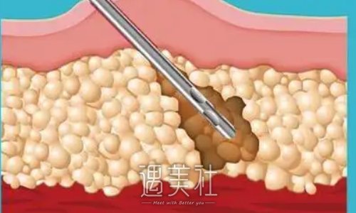合肥左宗宝医生面部吸脂怎么样？2022招牌体验案例展示 width=