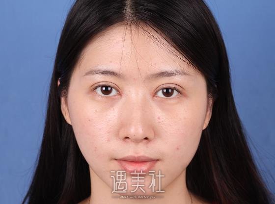 长春尹慧玲双眼皮修复案例公开｜2022亲身恢复果图集中一览 width=