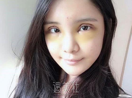 石家庄李海霞医生做的眼睛怎么样？2022全新体验案例分享 width=