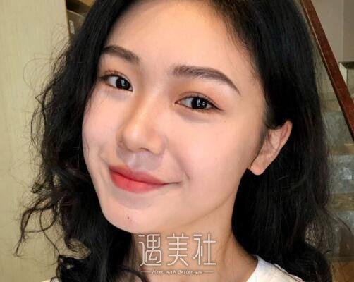 九院周慧芳去眼袋怎么样？2022体验案例公布 width=