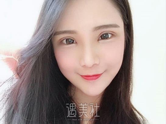 北京白永辉割双眼皮多少钱？亲身收费标准及案例一览 width=
