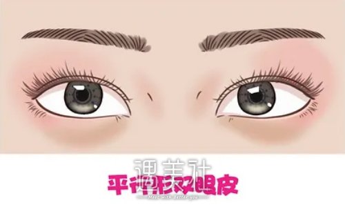福州黄循镭割双眼皮靠谱吗？2022体验案例曝光 width=