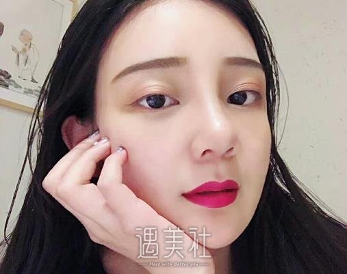 银川做隆鼻修复要多少钱？2022价格表及案例展示 width=
