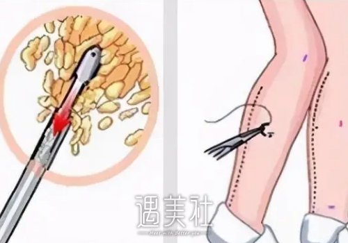 上海马杰医生吸脂怎么样？医生实力及案例公布 width=