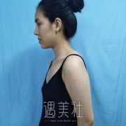 宁波刘成林医生自体脂肪移植丰胸案例，性感大胸的塑造 width=