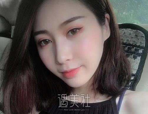 上海王业飞医生双眼皮做的怎么样？2022招牌案例一览 width=