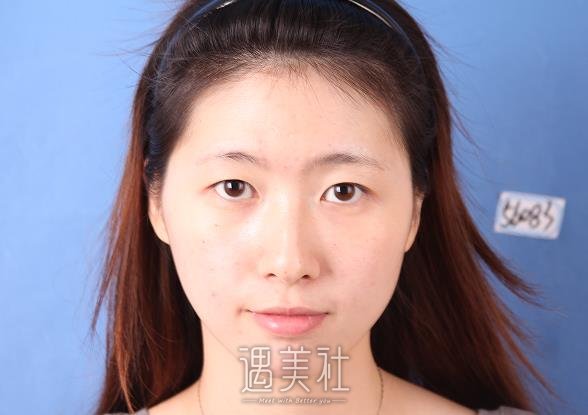 西安张沙沙做双眼皮怎么样？医生实力及案例出炉 width=