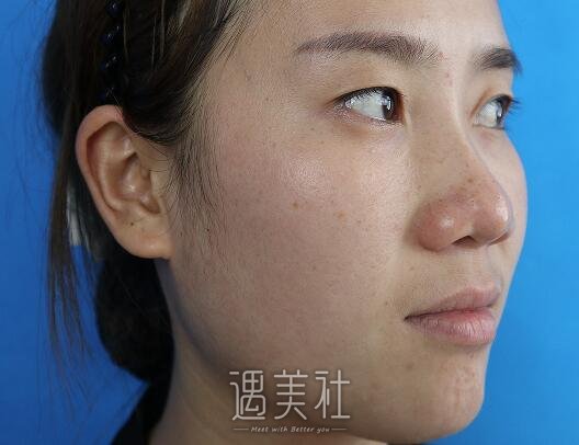 温州陈曦医生割双眼皮怎么样？2022招牌案例公布 width=