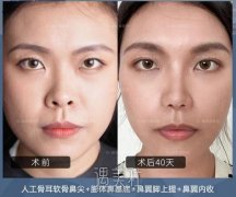 内入路保留鼻整形丨人工骨鼻尖+鼻基底填充 width=