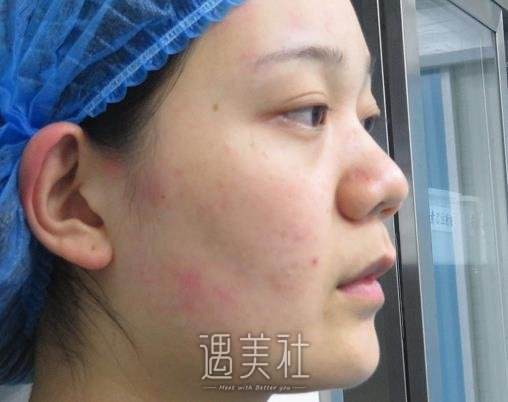 杭州吴志贤医生做鼻子案例公开｜内附体验果图 width=