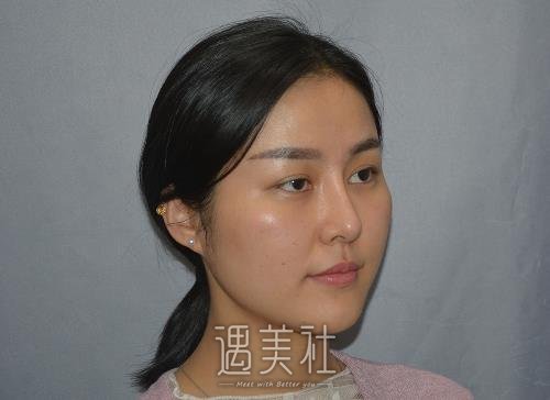 北京王世勇医生做双眼皮修复靠谱吗？2022招牌案例公布 width=