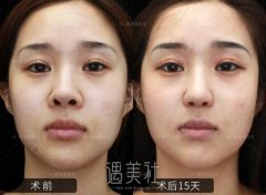 内入路保留鼻整形丨歪鼻矫正+鼻孔重塑 width=