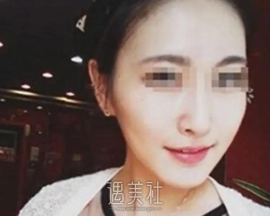 王珍祥做下颌角怎么样？医生实力靠谱吗？附全新体验案例 width=