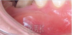 26根尖手术调节一例 width=