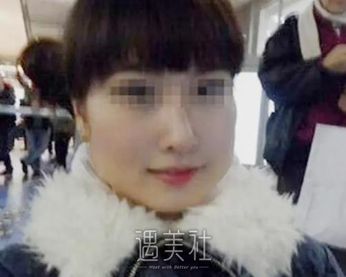 苏州磨骨手术需要多少钱？当地收费标准及案例公开 width=
