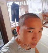 青岛诺德做的发际线植发果咋样？植发后头发会掉吗 width=