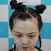 武汉仁爱植发果不错，4年还好好的！ width=