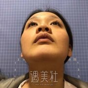 深圳艺星整形做假体隆鼻果如何呢？果图分享 width=