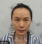 上海大麦植发案例，发际线移植之后脸型都有所改变 width=