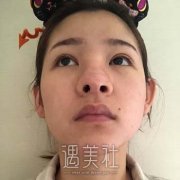 蒋代为案例|修复鼻子怎么样？从手术恢复图片来看 width=