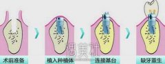 现在的种植牙多少钱一颗？价格受哪些因素影响呢？ width=