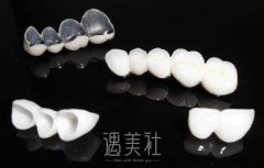 烤瓷牙的种类有哪些？烤瓷牙的价格贵不贵？ width=