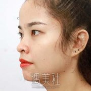 割完双眼皮七天恢复照片，给姐妹们参考一下 width=