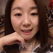 刘体亮医生种植牙案例解析，不疼比拔牙还轻松 width=