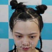 宿州市立医院整形外科微针植发案例，摆脱头发稀疏的尴尬 width=
