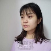 赵德星隆鼻案例分享，打造精致美观的鼻部形态 width=