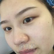 广州华美陈敏亮埋线双眼皮整形案例，塑造精致的眼眸 width=