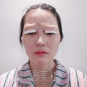 西昌市盛妆羽禾整形美容诊所正规吗？内附双眼皮案例更新 width=