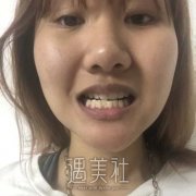 华泽乾医生种植牙案例，改良缺失，拥有整齐牙齿 width=