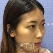 徐靖宏隆鼻案例，实力大咖隆鼻效果图展示 width=