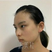 普宁市人民医院张卓群双眼皮整形案例，精致美眼塑造 width=