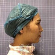 中国医学科学院整形外科医院蒋海越隆鼻案例，打造精致鼻子 width=