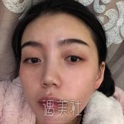 屠龙刀双眼皮修复案例，让眼睛宛若天生 width=