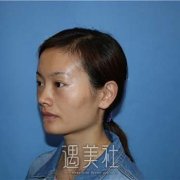 脂肪填充1-20天恢复图，面部脂肪填充后年轻了好多 width=
