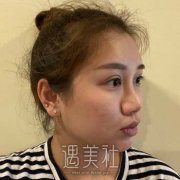 刘春伟医生鼻修复案例，打造微创且自然的鼻部形态 width=