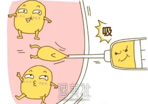 土麦森吸脂跟正常吸脂区别大吗？恢复期快吗？ width=
