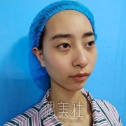 双眼皮手术第一天图片，每日恢复日记前后效果对比图 width=