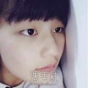 常州李玲巧双眼皮案例，离近看没有什么手术痕迹 width=