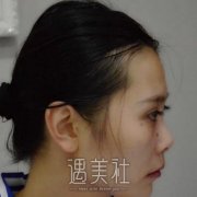 整鼻子失败修复案例图，二次隆鼻变成混血美女 width=