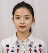 磨骨手术过程真实图片，术后拥有精致的鹅蛋脸 width=