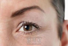 上眼睑切皮手术好吗？多久恢复自然？科普解答送给你 width=