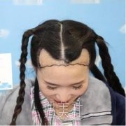 植发3个月恢复图片，看看疤痕植发2个月、3个月效果图 width=