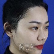 硅胶隆鼻85天效果一览，切口也恢复的差不多，不注意看根本就看不出来 width=