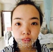 想要做地包天矫正？先看看地包天正畸矫正案例分享 width=
